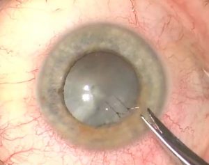 perforación corneal