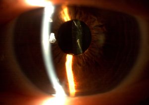 Lente intraocular