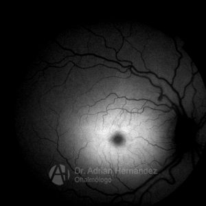 SIALIDOSIS AUTOFLUORESCENCIA
