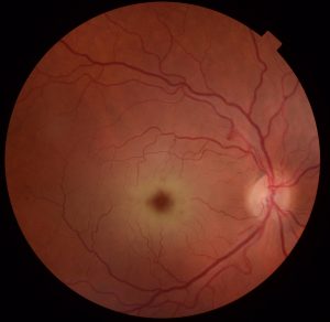 SIALIDOSIS RETINIANA RETINOGRAFIA
