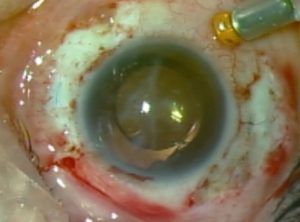 SUTURA SULCUS