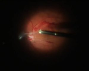 retinopatía diabética proliferativa