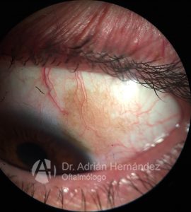 MELANOSIS CONJUNTIVAL