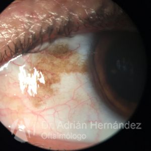 MELANOSIS CONJUNTIVAL