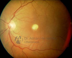 CANDISIASIS RETINIANA