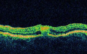CANDIDIASIS RETINIANA oct