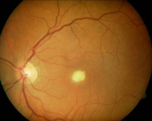CANDISIASIS RETINIANA 4