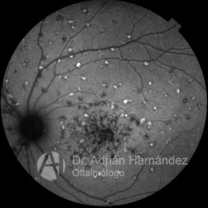 Stardgart autofluorescencia