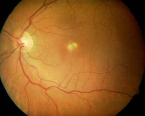 CANDISIASIS RETINIANA 2