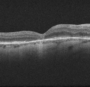 agujero macular cerrado