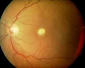 CANDISIASIS RETINIANA 5