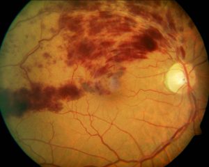 TROMBOSIS RETINA