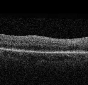 Pliegue retiniano