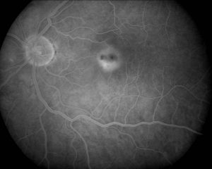 CANDIDIASIS RETINIANA agf