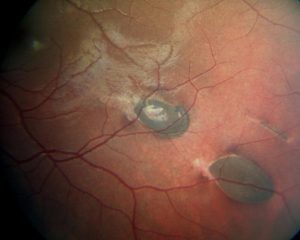 hipertrofia congénita de epitelio pigmentario de la retina