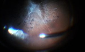 desprendimiento de retina traccional