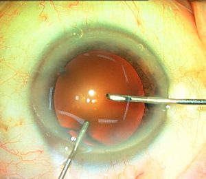 capsulorrexis