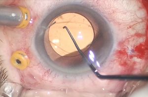 Implante lente sulcus