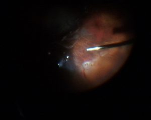 Desgarro de retina