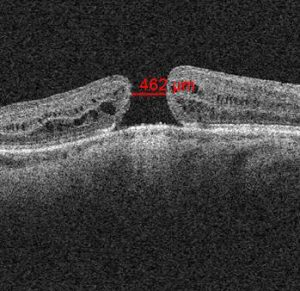 agujero macular