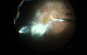 retinopatía diabética proliferativa