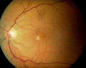 CANDISIASIS RETINIANA 1