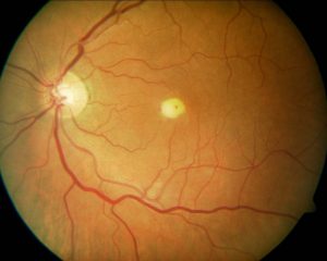 CANDISIASIS RETINIANA 3