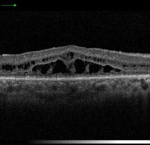 Retinosquisis juvenil OCT