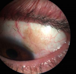 MELANOSIS CONJUNTIVAL