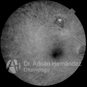 NEVUS COROIDEO