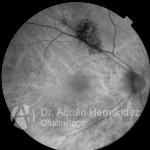 NEVUS COROIDEO