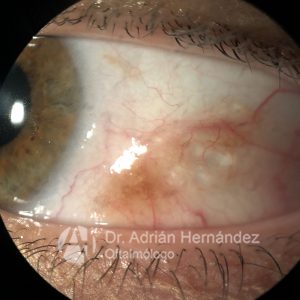 NEVUS CONJUNTIVAL