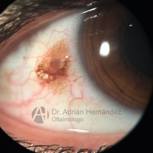 NEVUS CONJUNTIVAL