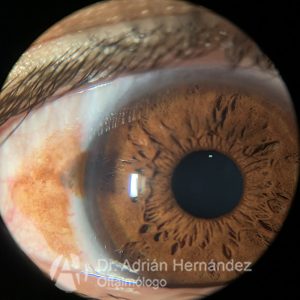 NEVUS CONJUNTIVAL