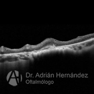 NEVUS COROIDEO