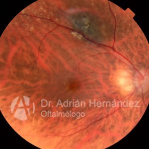 NEVUS COROIDEO