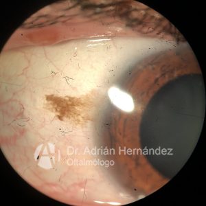 NEVUS CONJUNTIVAL