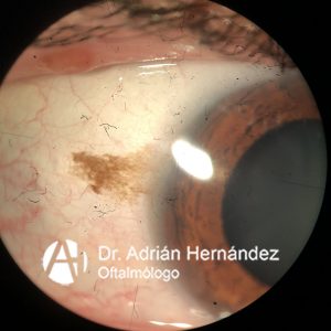 NEVUS CONJUNTIVAL