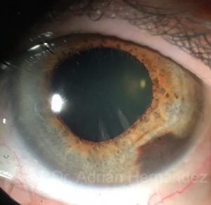 NEVUS IRIS