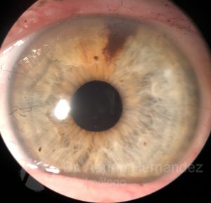 NEVUS IRIS