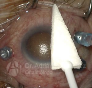 glaucoma neovascular