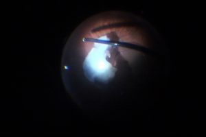 luxación de núcleo a vítreo