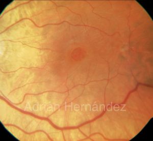 AGUJERO MACULAR RETINO