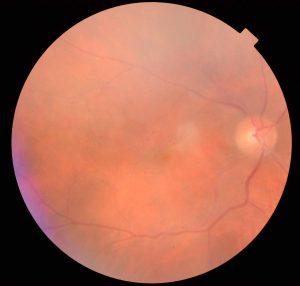 Pliegue retiniano