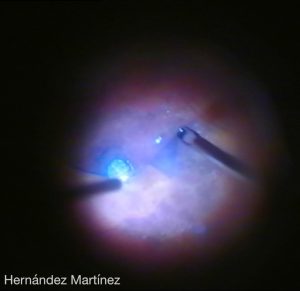 Cirugía agujero macular