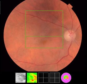 Pliegue retiniano