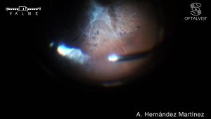 desprendimiento de retina traccional