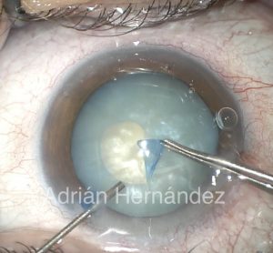 CAPSULORREXIS