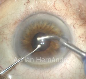 miosis intraoperatoria