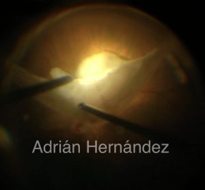 RESTOS NUCLEARES SUBRETINIANOS